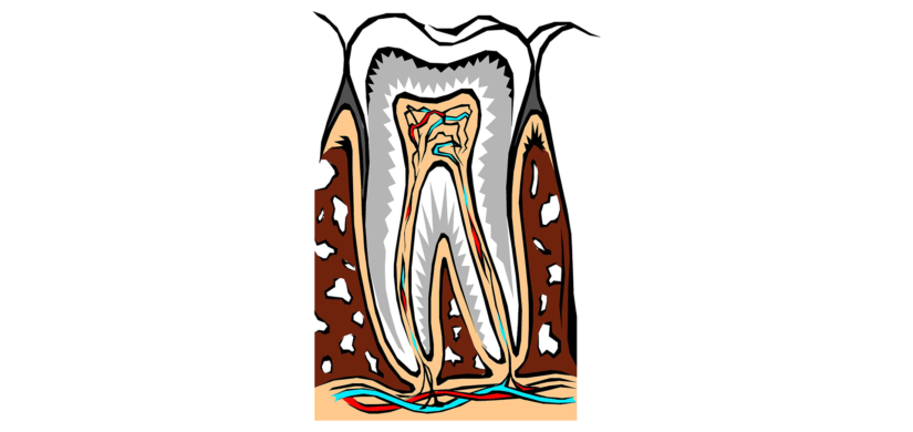 root-canal-03