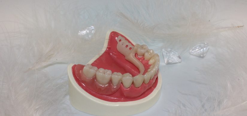 tooth-replacement-759925_1280